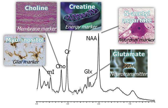 MRI siêu nhanh phát hiện hóa học não sống – Bước ngoặt mới trong chẩn đoán sớm bệnh lý thần kinh